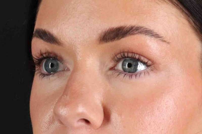 Blepharoplasty (Eyelid Surgery) Before & After Patient #4503