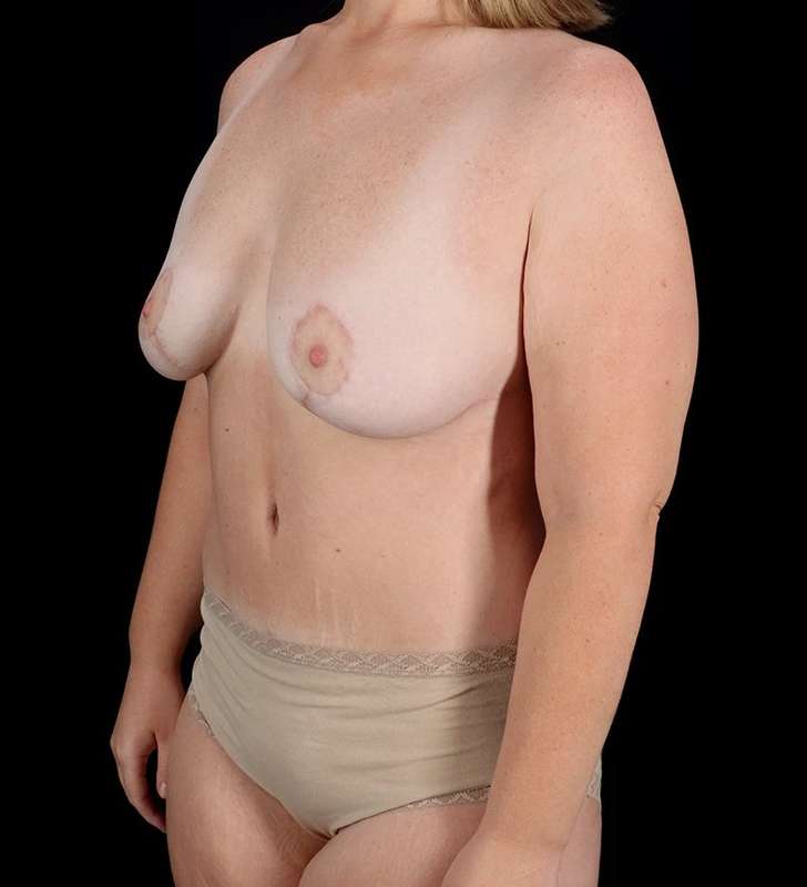 Abdominoplasty (Tummy Tuck) Before & After Patient #1001