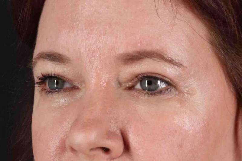 Blepharoplasty (Eyelid Surgery) Before & After Patient #4536