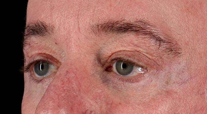 Blepharoplasty (Eyelid Surgery) Before & After Patient #4599