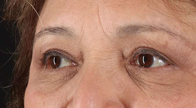 Blepharoplasty (Eyelid Surgery) Before & After Patient #4649