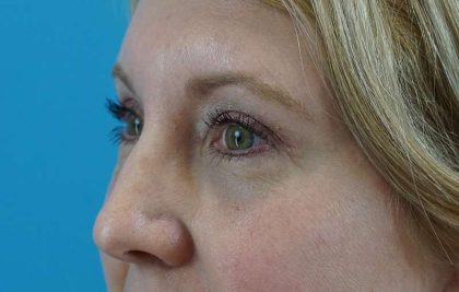 Brow Lift Before & After Patient #4672