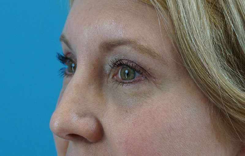 Brow Lift Before & After Patient #4672