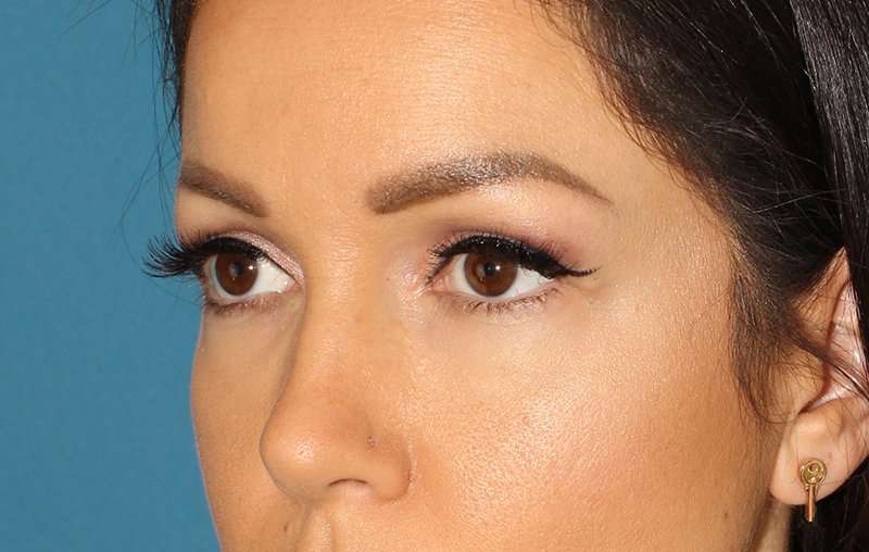 Brow Lift Before & After Patient #4690