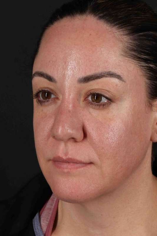 Brow Lift Before & After Patient #4733