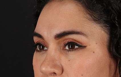 Brow Lift Before & After Patient #4744