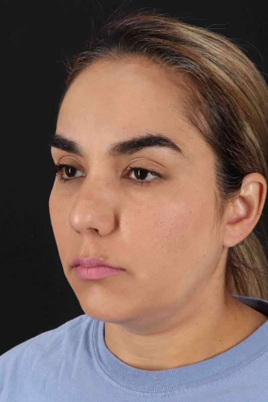 Brow Lift Before & After Patient #4755