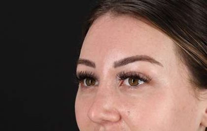 Brow Lift Before & After Patient #4766