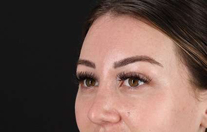 Brow Lift Before & After Patient #4766
