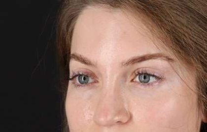 Brow Lift Before & After Patient #4777