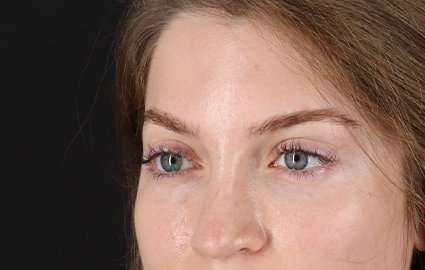 Brow Lift Before & After Patient #4777