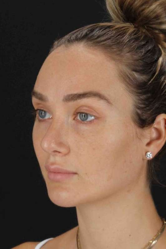 Brow Lift Before & After Patient #4799