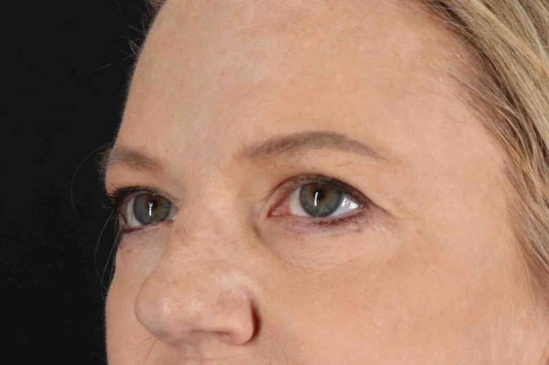 Brow Lift Before & After Patient #4854
