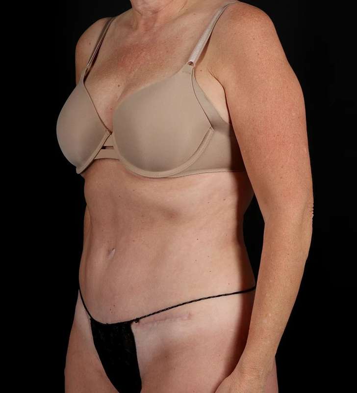 Abdominoplasty (Tummy Tuck) Before & After Patient #1029