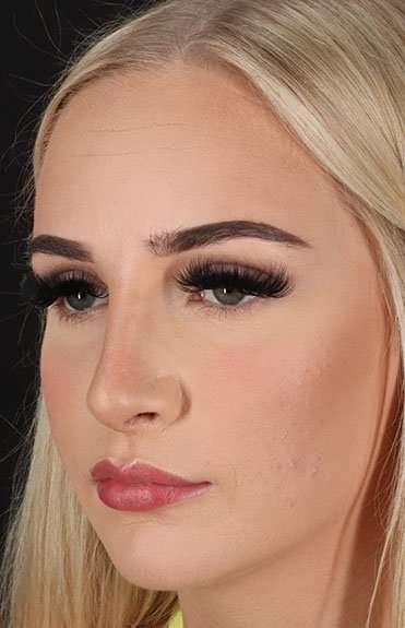 Brow Lift Before & After Patient #4876