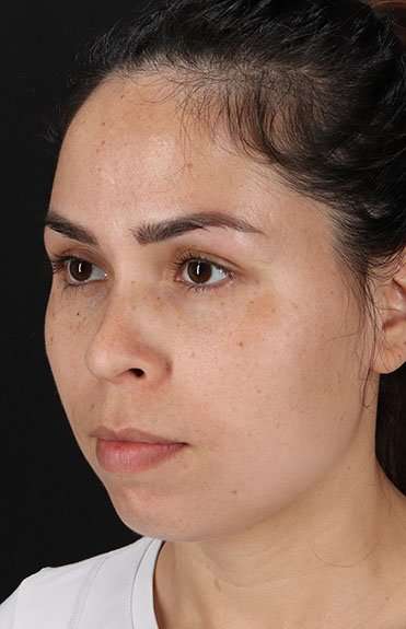 Cosmetic Injectables Before & After Patient #4990