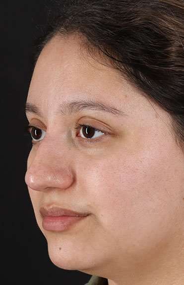 Cosmetic Injectables Before & After Patient #5001