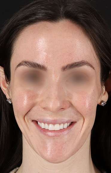 Cosmetic Injectables Before & After Patient #5016