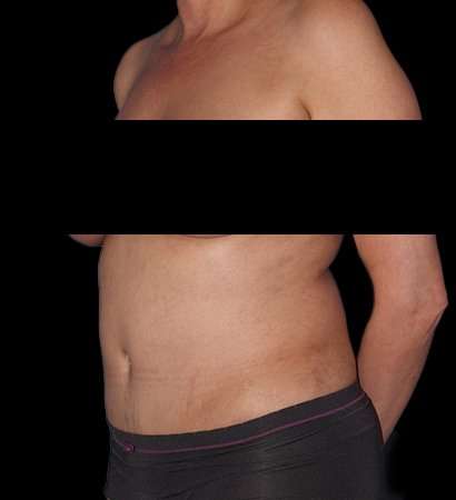 Abdominoplasty (Tummy Tuck) Before & After Patient #590