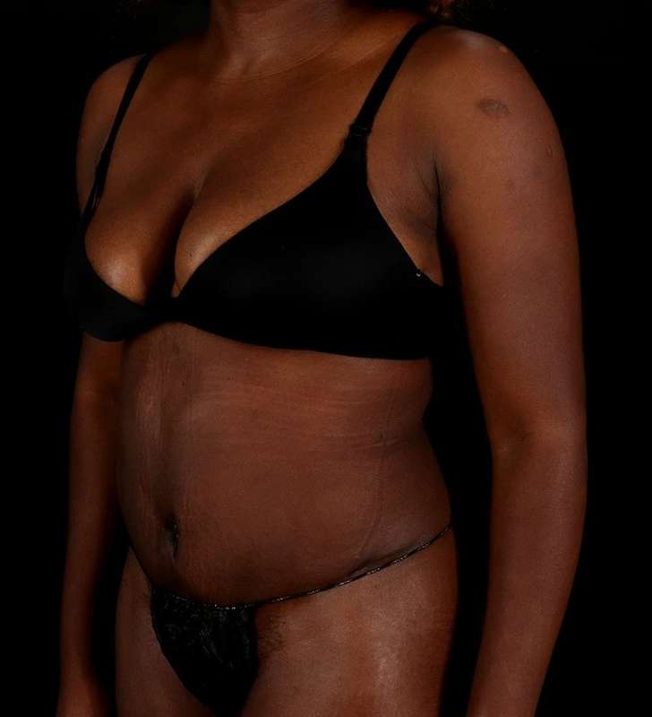 Abdominoplasty (Tummy Tuck) Before & After Patient #1045