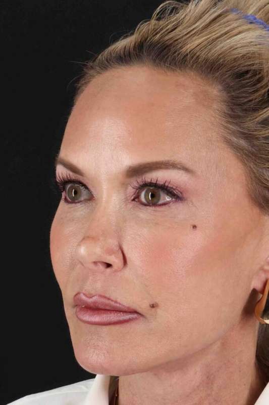Facelift Before & After Patient #5119