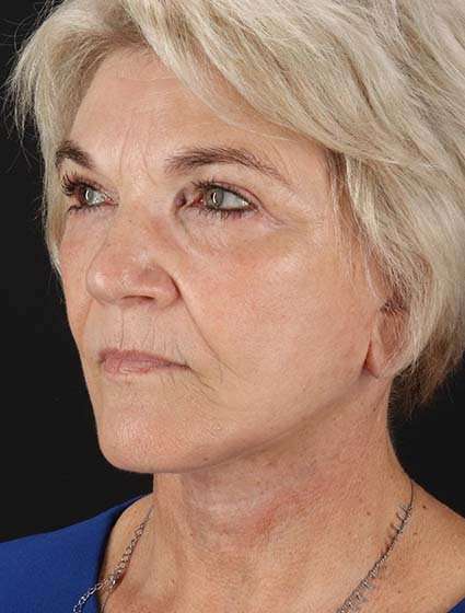 Facelift Before & After Patient #5163