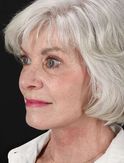 Facelift Before & After Patient #5174