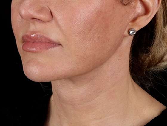 Facelift Before & After Patient #5185