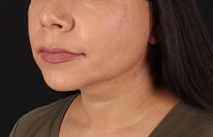 Facelift Before & After Patient #5251