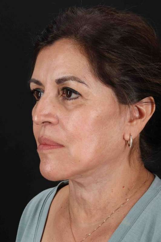 Facelift Before & After Patient #5284