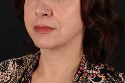 Facelift Before & After Patient #5315