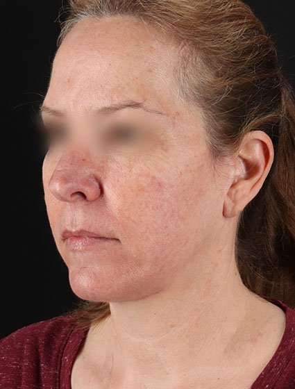 Facelift Before & After Patient #5359