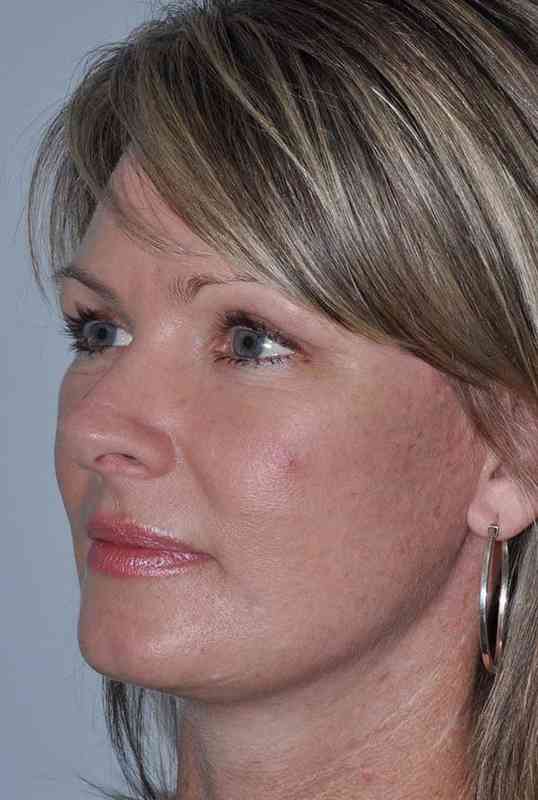 Facelift Before & After Patient #5385