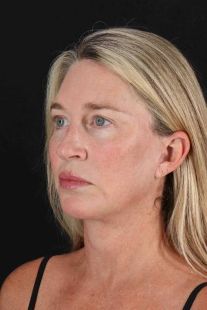 Facelift Before & After Patient #5488
