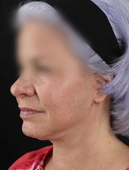 Facelift Before & After Patient #5499