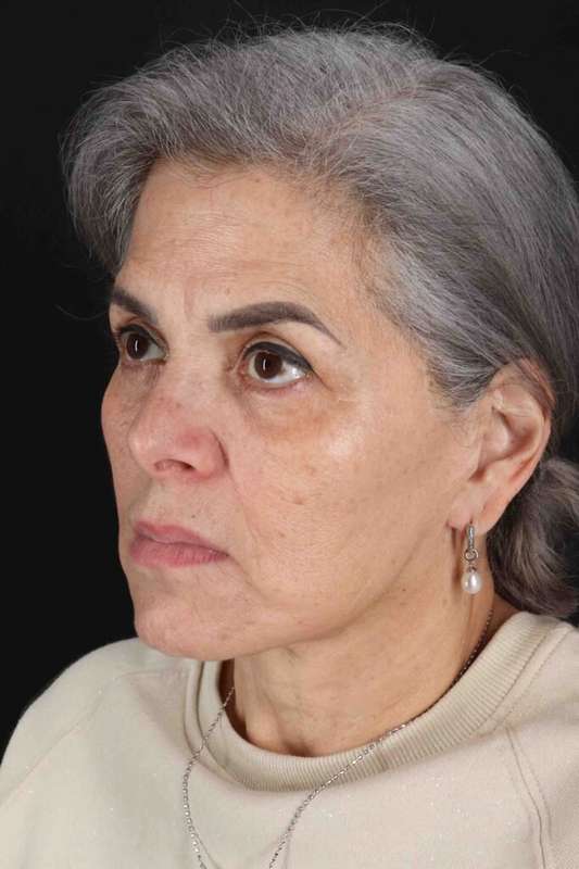 Facelift Before & After Patient #5510