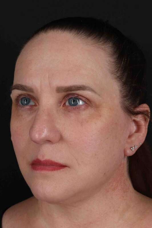 Facelift Before & After Patient #5521