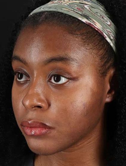 Chemical Peels Before & After Patient #5568
