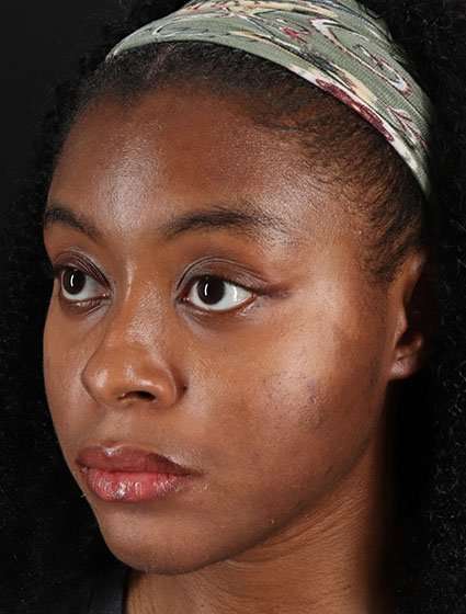 Chemical Peels Before & After Patient #5568