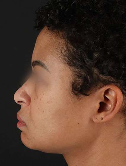 Chemical Peels Before & After Patient #5610