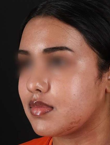Chemical Peels Before & After Patient #5621