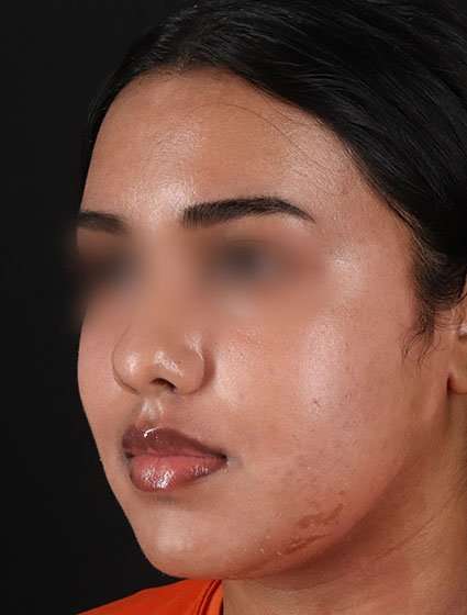 Chemical Peels Before & After Patient #5621