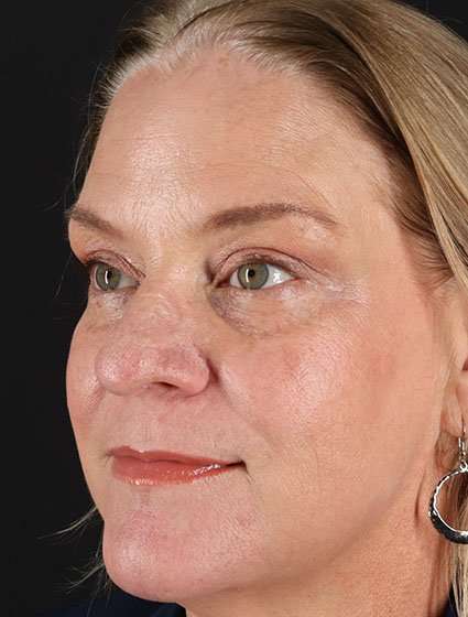 Chemical Peels Before & After Patient #5632