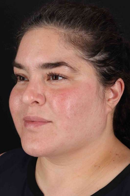 Neck Liposuction Before & After Patient #5643