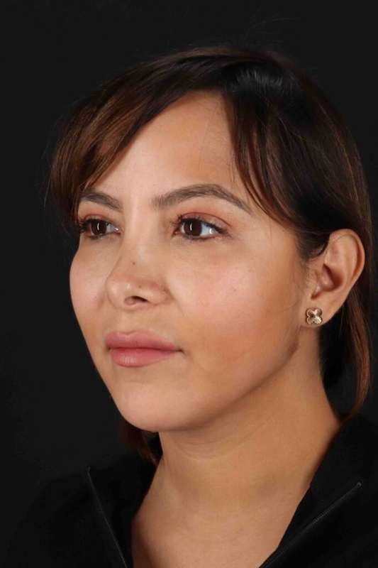 Neck Liposuction Before & After Patient #5654