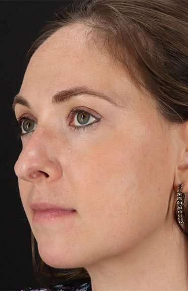 Neck Liposuction Before & After Patient #5687