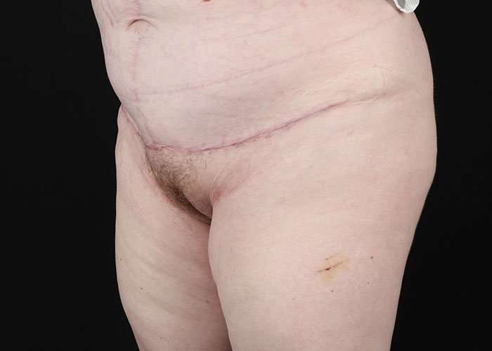 Monsplasty Before & After Patient #1117