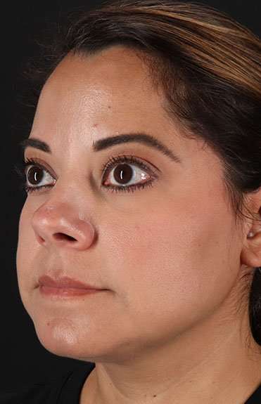 Neck Liposuction Before & After Patient #5720