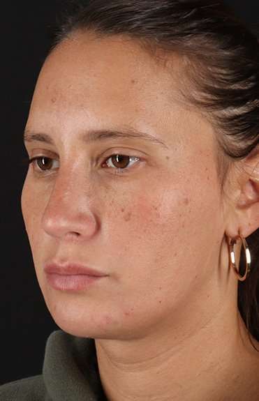 Neck Liposuction Before & After Patient #5753