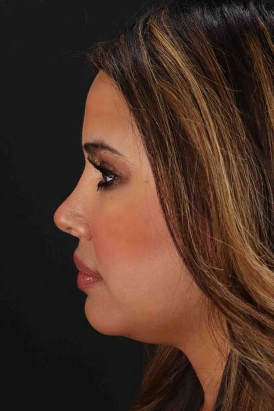 Neck Liposuction Before & After Patient #5762